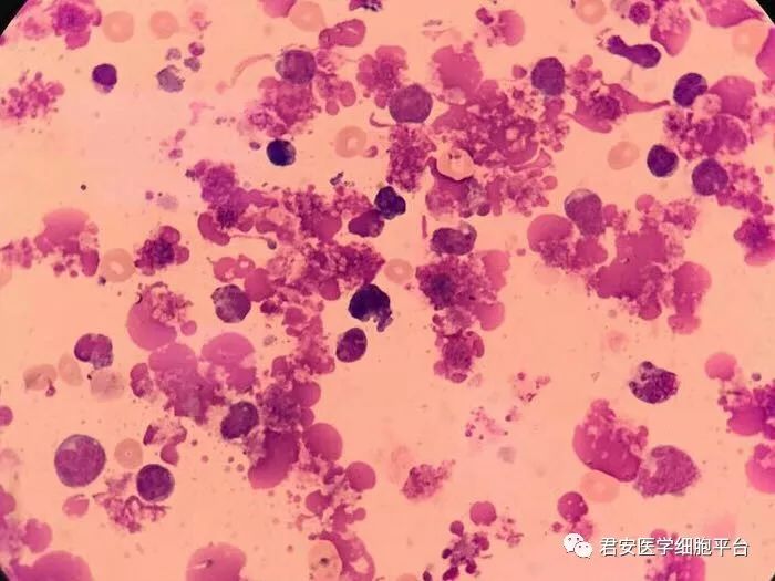最新T淋巴母细胞瘤治疗技术，科普解读、前沿洞察与进展
